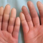 Esclerose Sistêmica, Quando As Pontas Dos Dedos Mudam De Cor