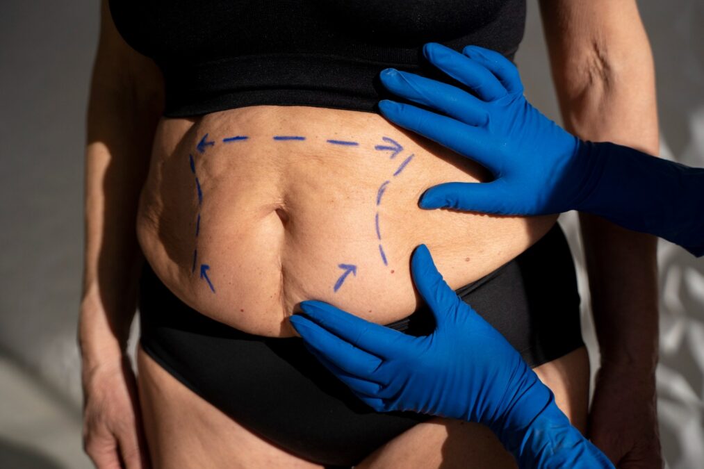 Abdominoplastia: 5 Coisas Que é Preciso Saber Antes De Fazer